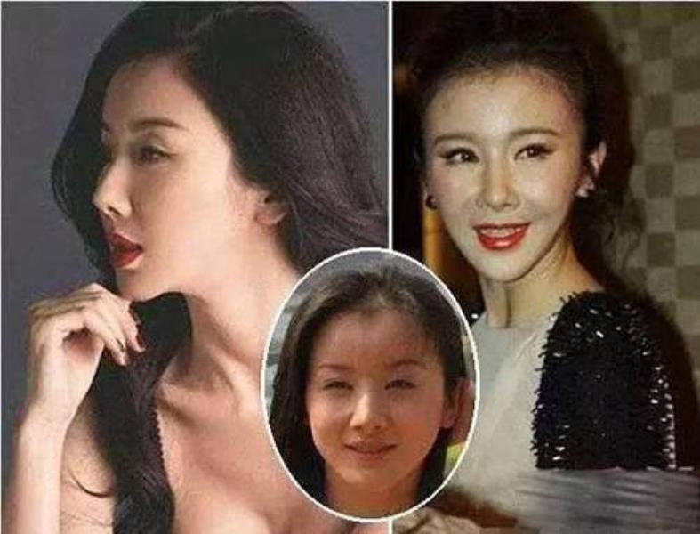 削骨多久能恢复(面部截骨多久时间可以恢复)(20)