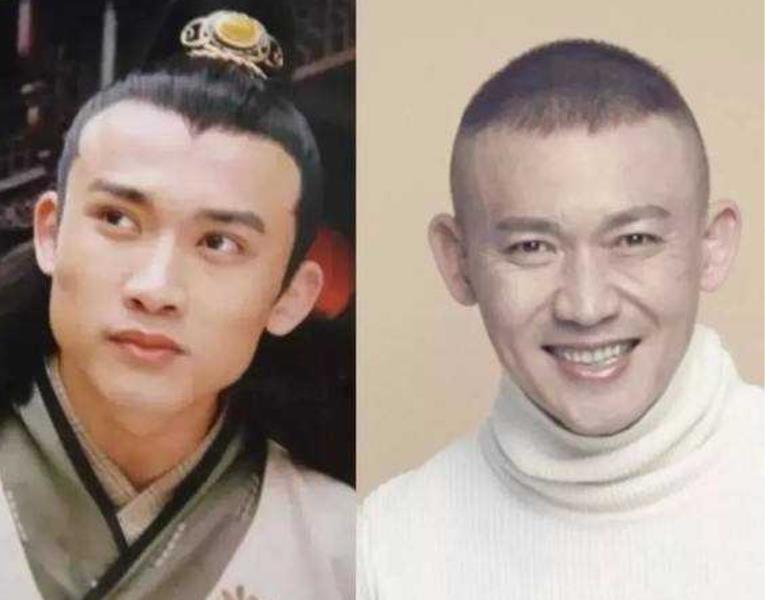 削骨多久能恢复(面部截骨多久时间可以恢复)(26)