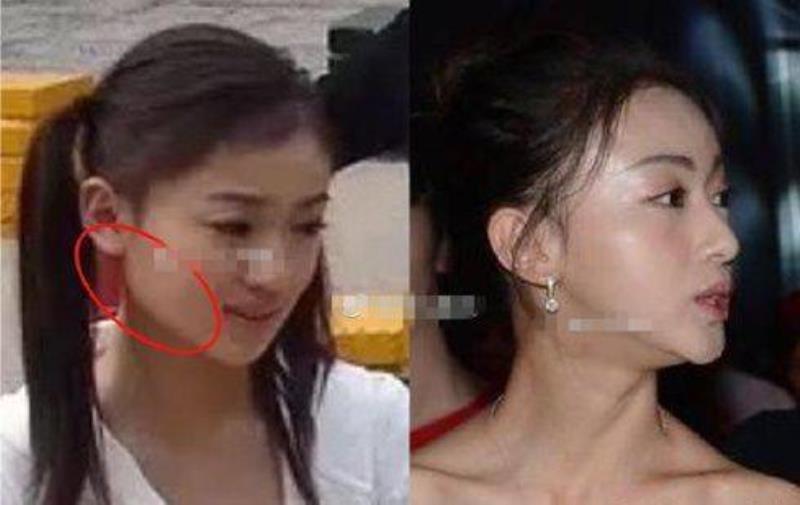 削骨多久能恢复(面部截骨多久时间可以恢复)(29)