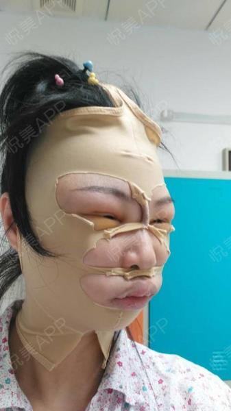 削骨多久能恢复(面部截骨多久时间可以恢复)(49)