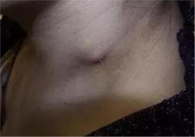 鱼刺卡在喉咙的小方法（鱼刺卡住喉咙的急救方法）(4)